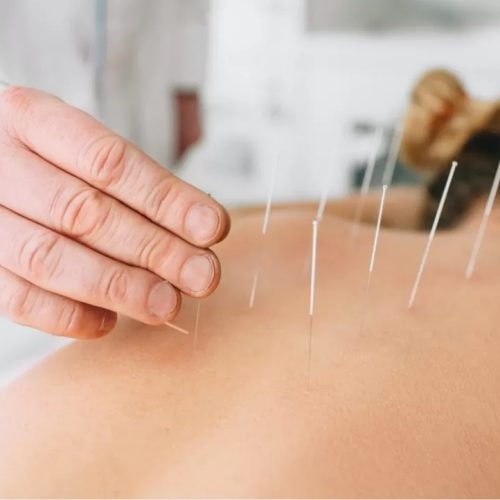 Dry Needling